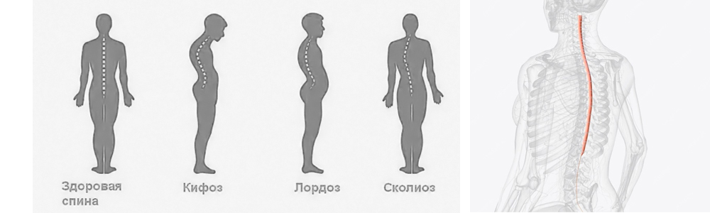 Заболевания осанки Заболевания осанки