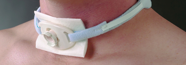 Ларингэктомия